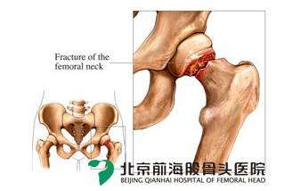 激素型男科应该如何治疗